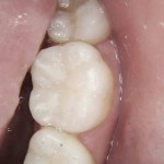 Teeth Fillings West Covina